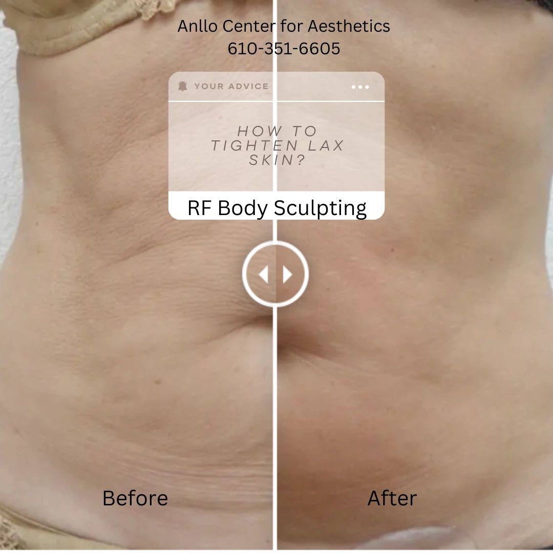 Tighten up Loose Skin with our RF Body Sculpting Treatment