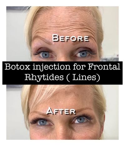 Before and after Botox treatment showing reduced forehead wrinkles.