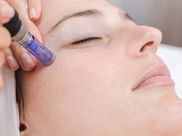 microneedling in south florida