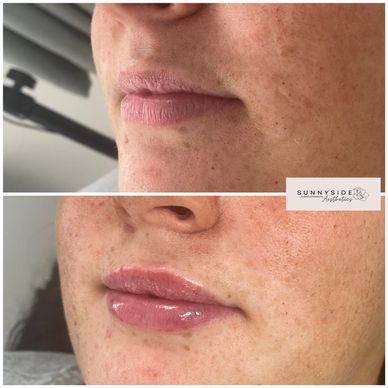 lip filler before and after for the first time