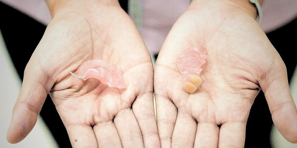 image of broken partial denture in a person's hands