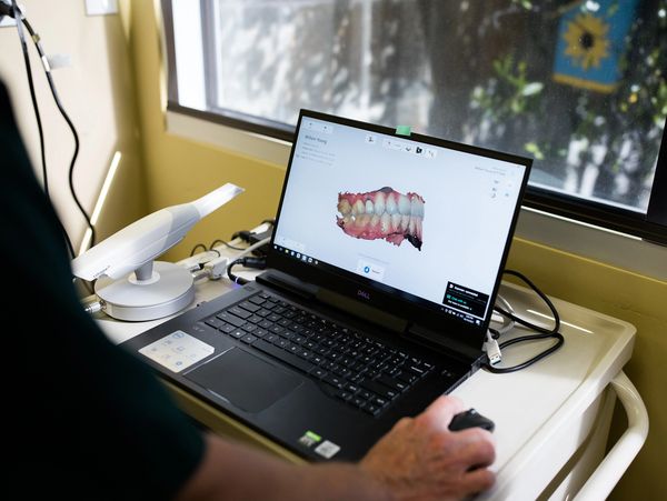 Dr. Softley views a 3D image of teeth on a computer using an intraoral scanning device. 