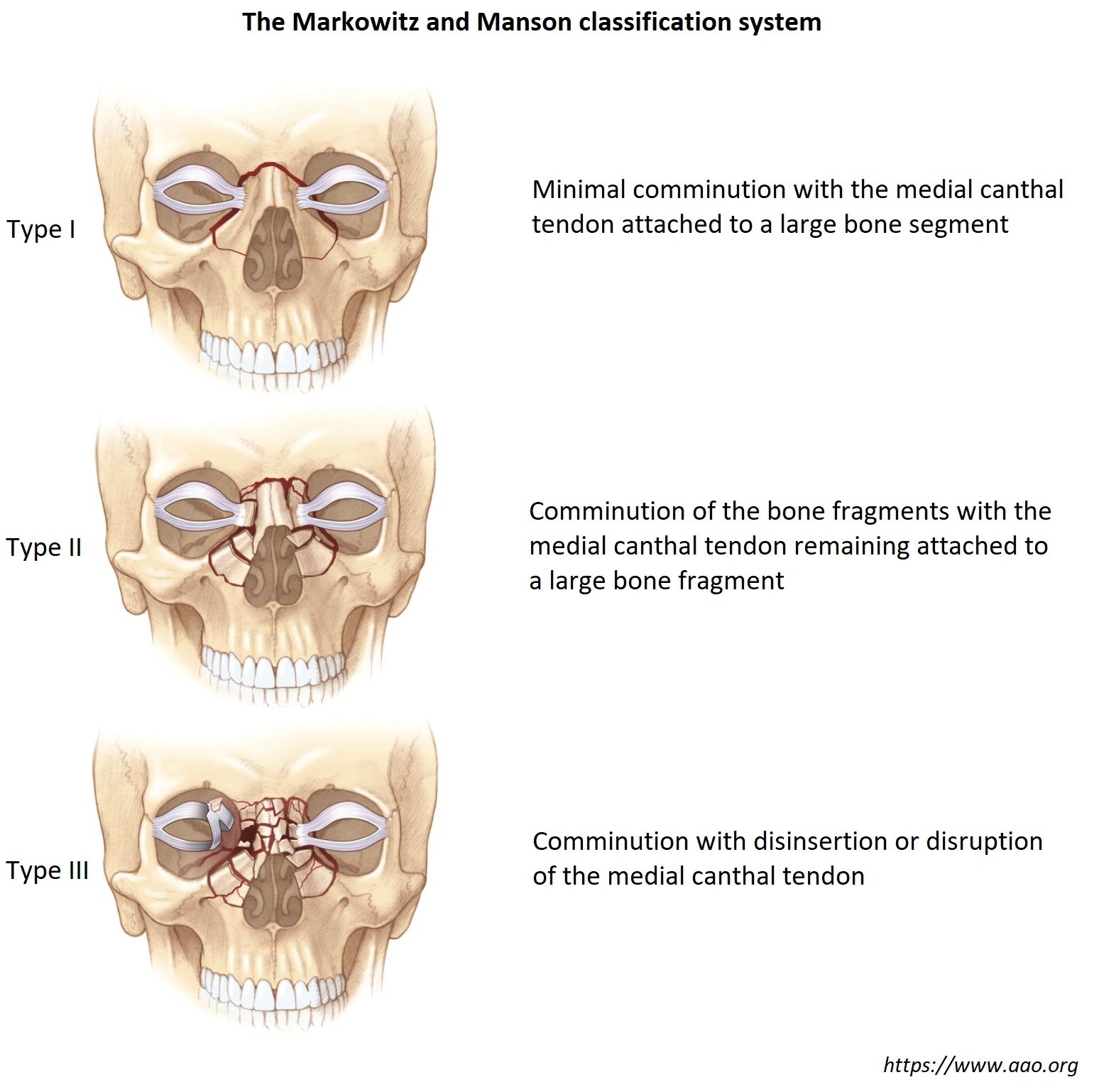 NOE Fractures