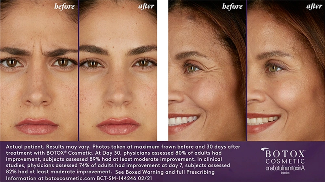 Frown Lines Between Eyes, Facial Fillers Under Eyes, Smile Lines Just