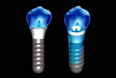 implantes dentales