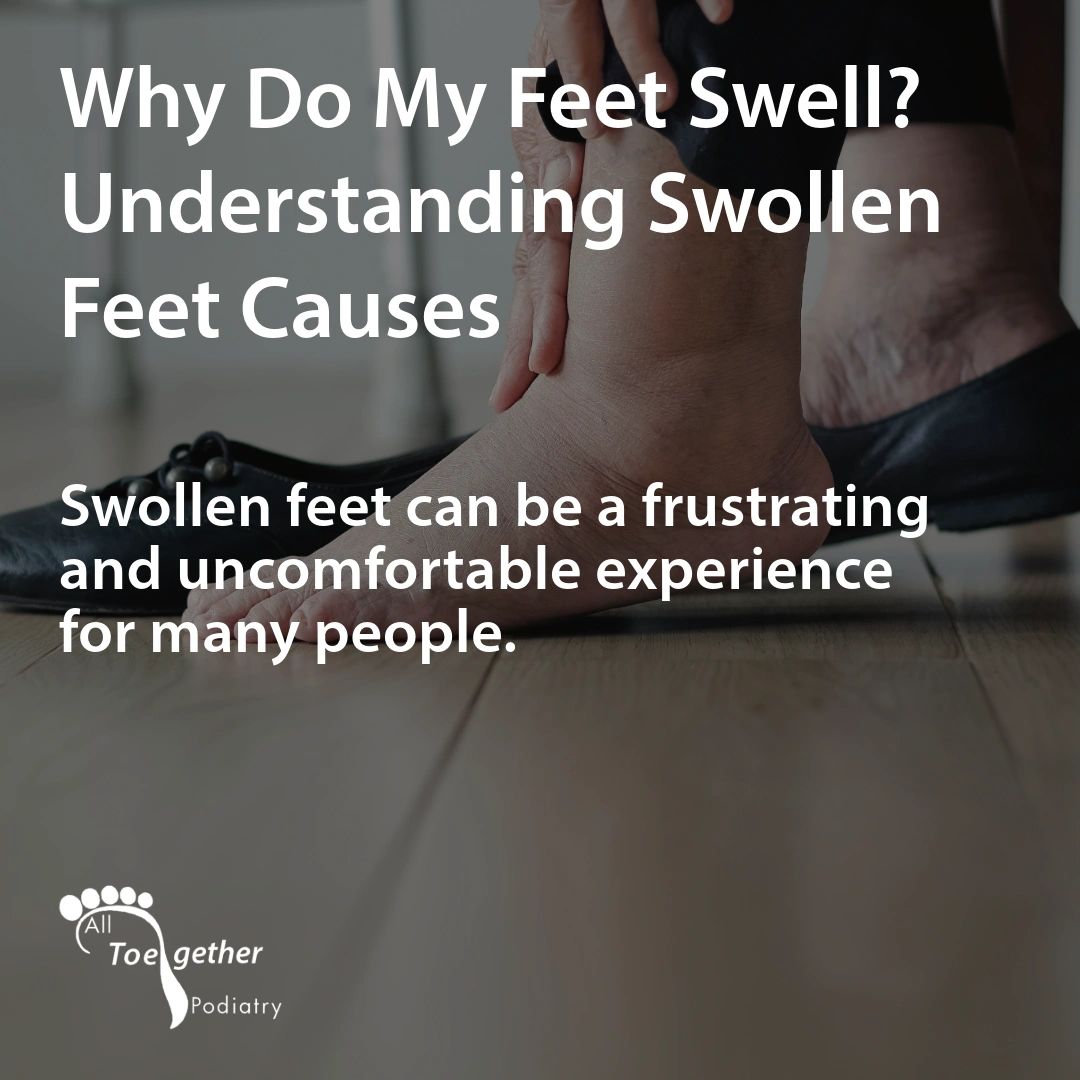 Why Do My Feet Swell? Understanding Swollen Feet Causes