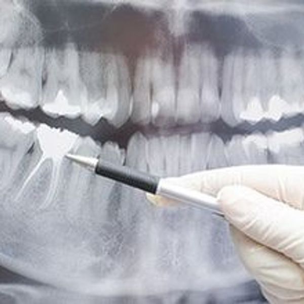 Diagnostics & Treatment Planning
Oral Hygiene - Prevention & Maintenance
Fillings
Crowns
Invisalign
