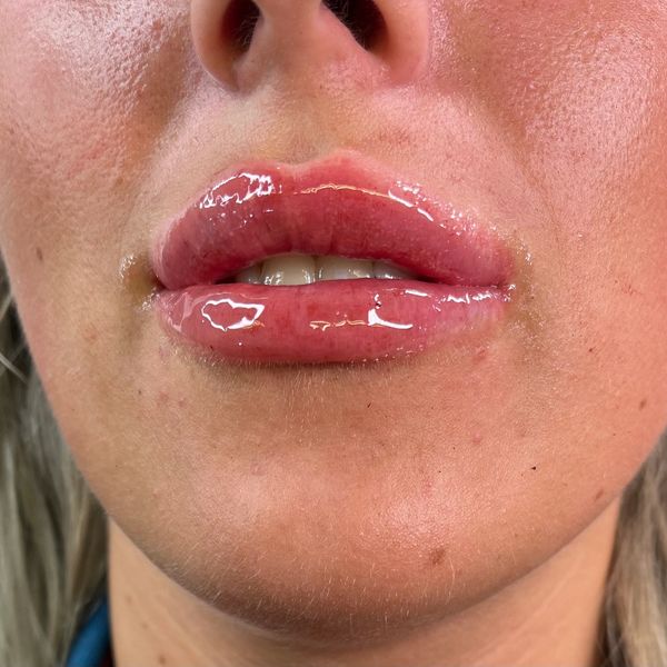 Close-up of glossy, plump lips with natural skin texture around.