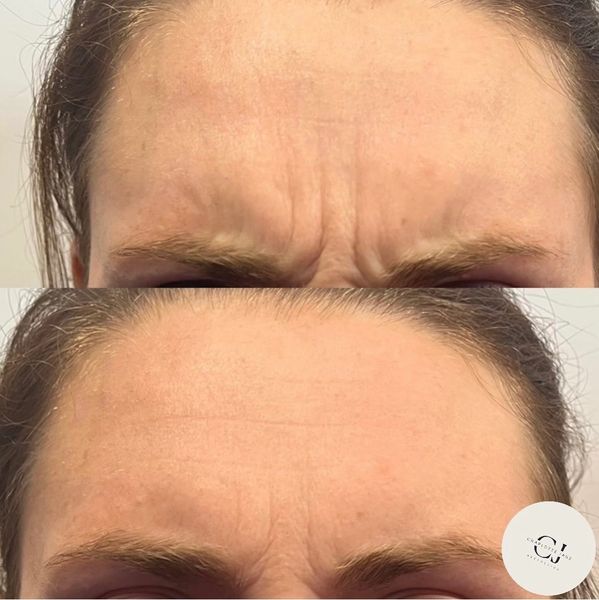 Close-up of a forehead showing frown lines before and after treatment.
