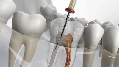 Endodontist appointments at Your Dental Spa Van Nuys CA