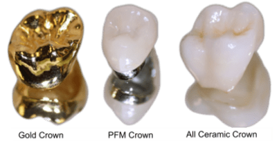 Dental crowns at Your Dental Spa Van Nuys CA