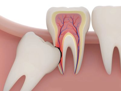 Wisdom Teeth Extraction Oral Surgery at Your Dental Spa Van Nuys CA