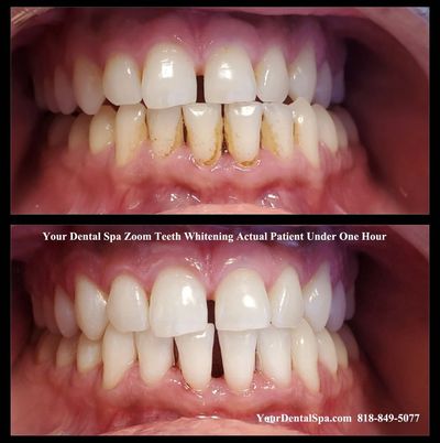 Zoom Teeth Whitening