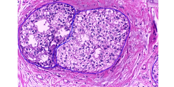 Histology slide with tumor