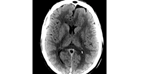 Head CT
