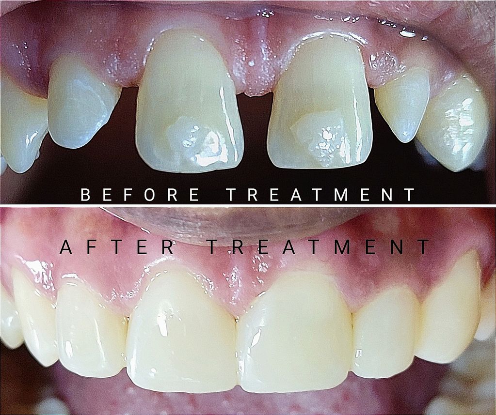 Large gaps present between upper front teeth region. Our cosmetic expert decided to go with direct v