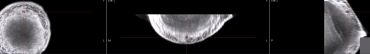 Three medical imaging scans showing a spherical object from different angles.