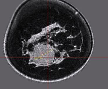 MRI scan showing a cross-sectional view with measurements.