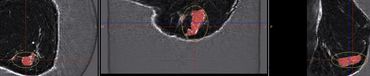 Cross-sectional MRI images showing a lesion in soft tissue.