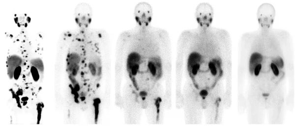 An example of successful prostate theranostics treatment in Germany (Kratochwil et al)