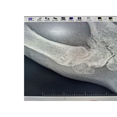 Thumb base arthritis xray