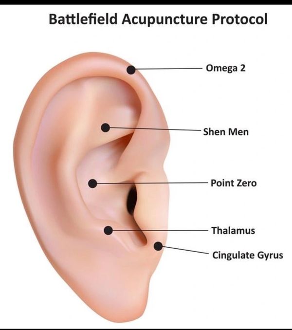 Diagram of an ear showing Battlefield Acupuncture Protocol points.
