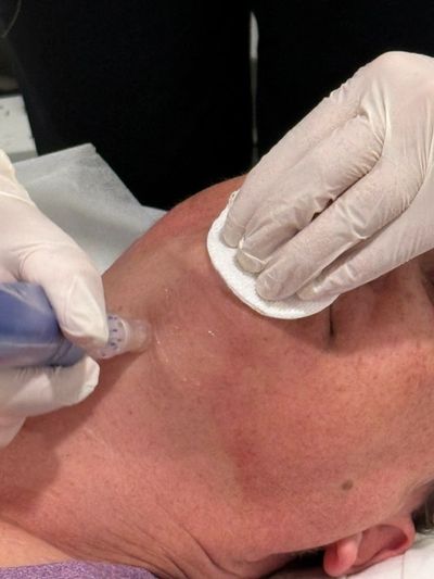 Microneedling treatment on the cheek.