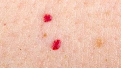 Two small red spots on skin.