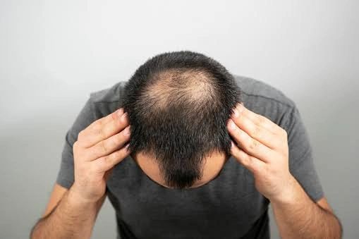 Hair Transplant Before and After  ClinicExpert
