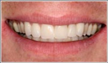 after Porcelain Veneers