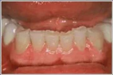 Before Zirconia Crowns