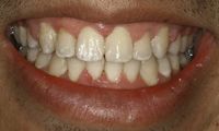 Invisalign Dentist Wilmington