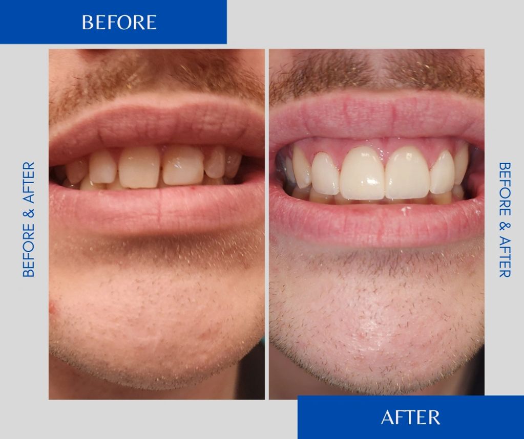 Before and after of maxillary anterior teeth.