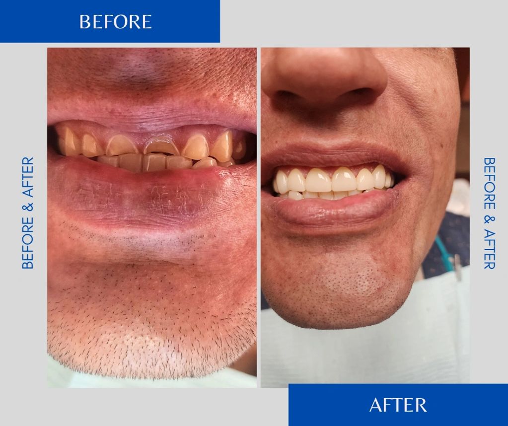 Before and after of full mouth restoration of dental crowns.