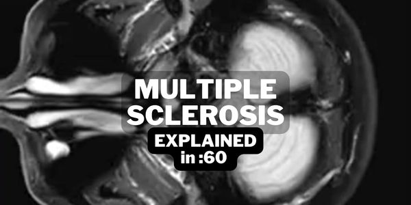 MRI of the central nervous system (CNS) showing multiple sclerosis lesions on the brain & spine.