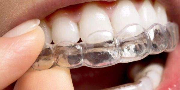 teeth with clear aligners