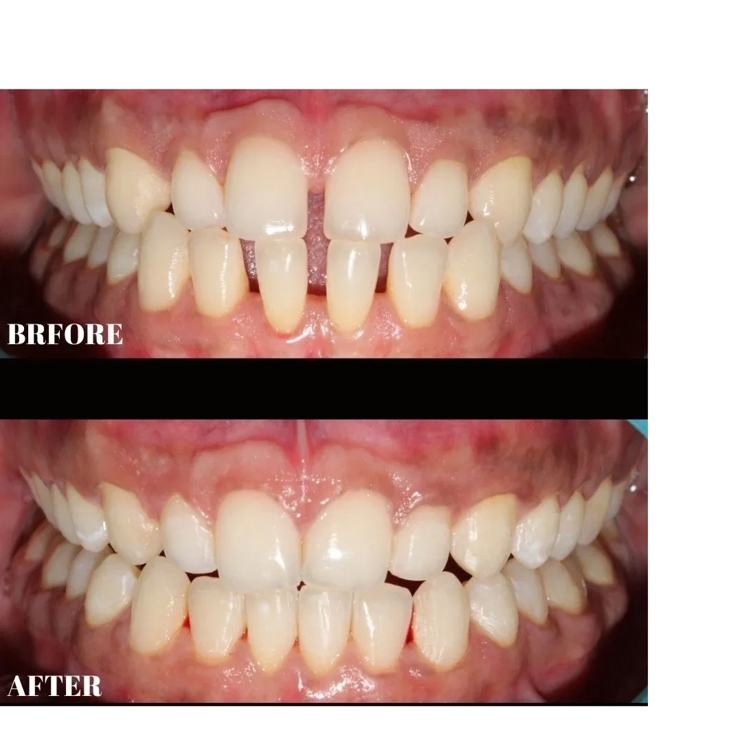 before after photo of teeth straightening with clear aligners.