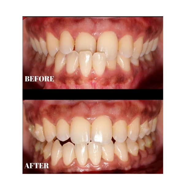 before after photo of teeth straightening with clear aligners.