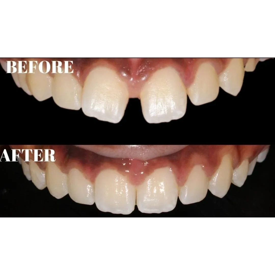 before after photo of teeth straightening with clear aligners.