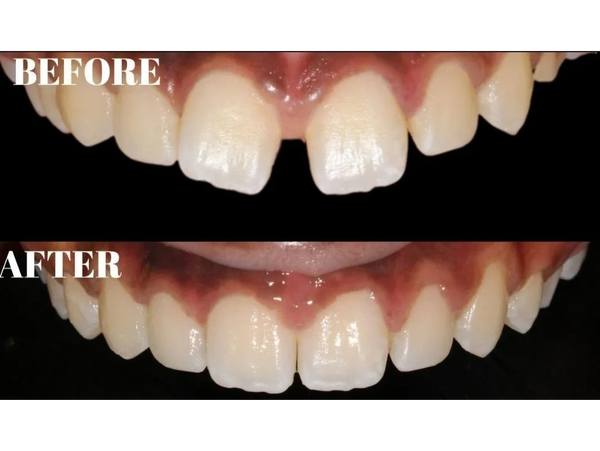 before after photo of teeth straightening with clear aligners.