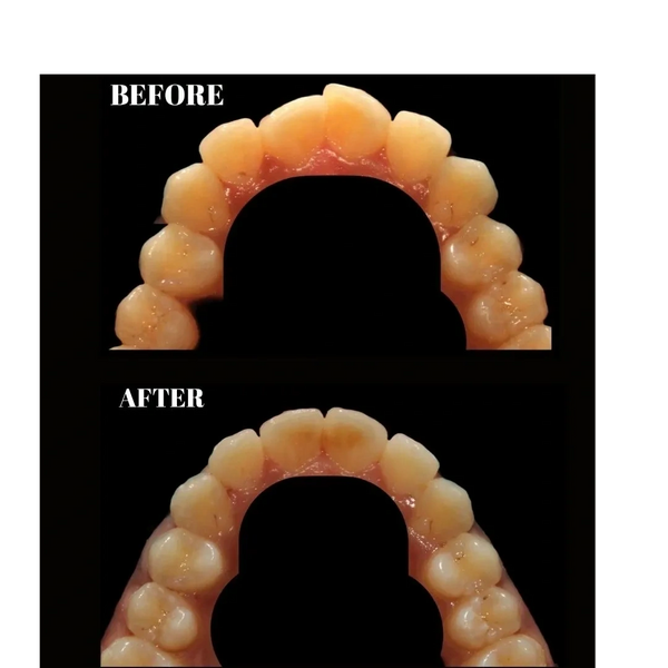 before after photo of teeth straightening with clear aligners.