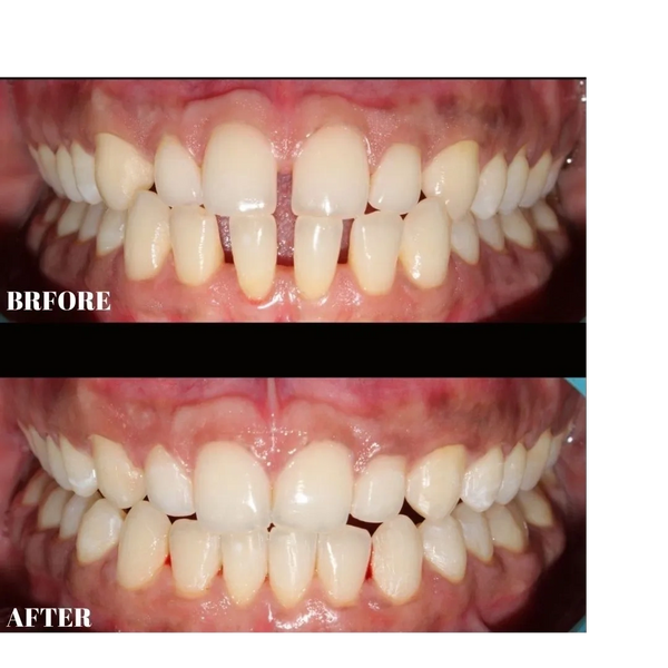 before after photo of teeth straightening with clear aligners.