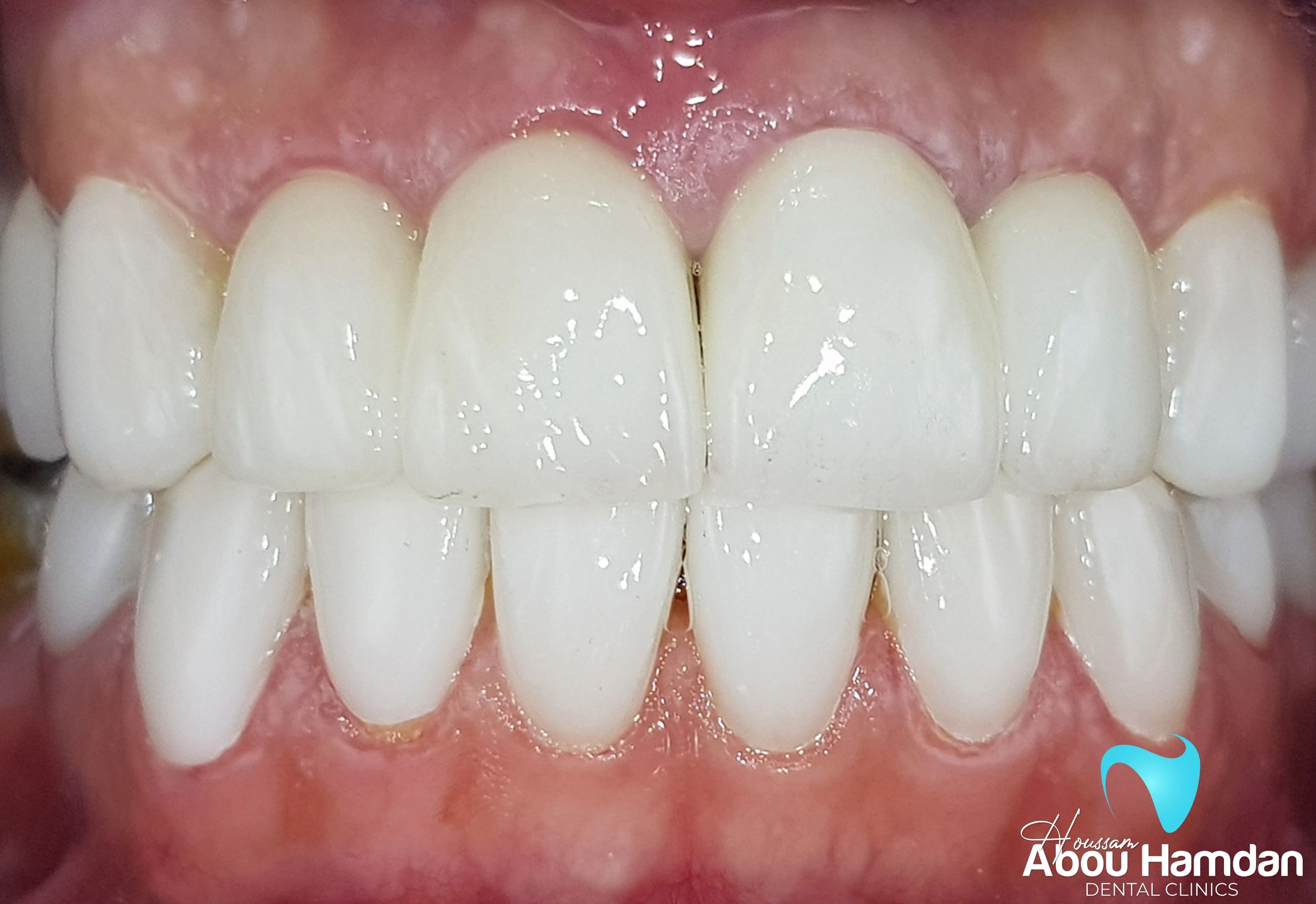Dental veneers after treatment