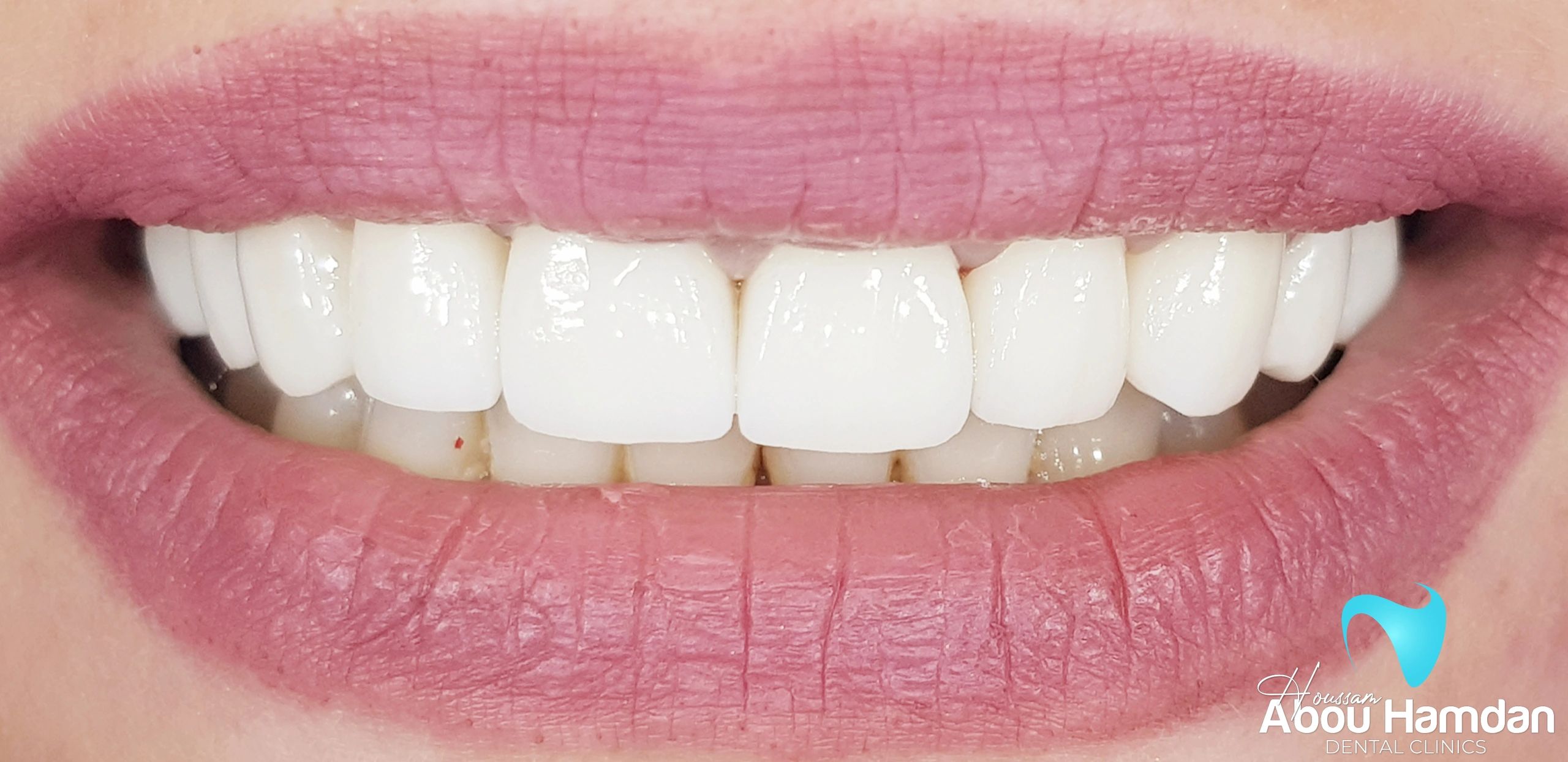 Dental veneers