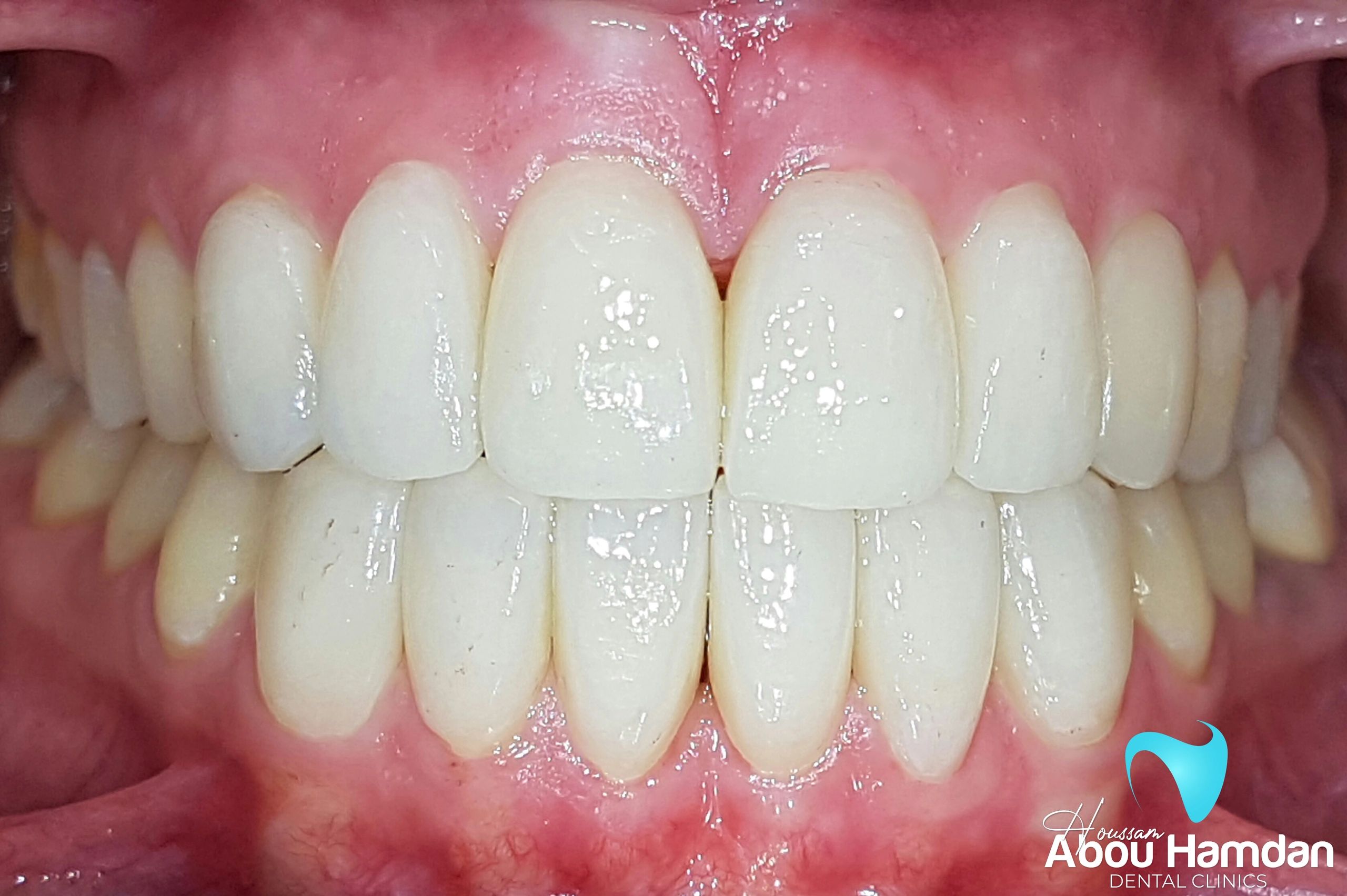 Porcelain veneers