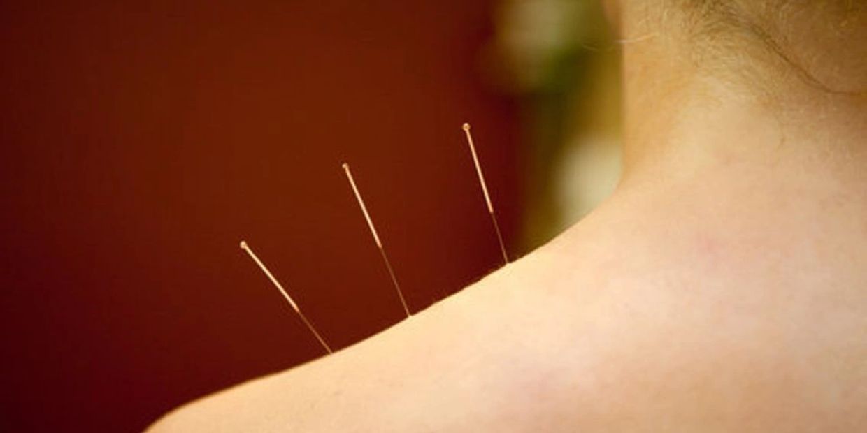Acupuncture in the upper traps to relieve muscular tension which can be helpful for headaches.