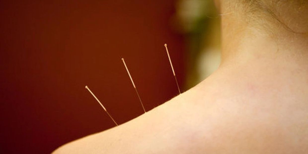 Acupuncture
