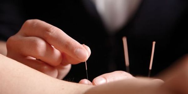 Dry needling technique is utilized for trigger points and pain relief. 