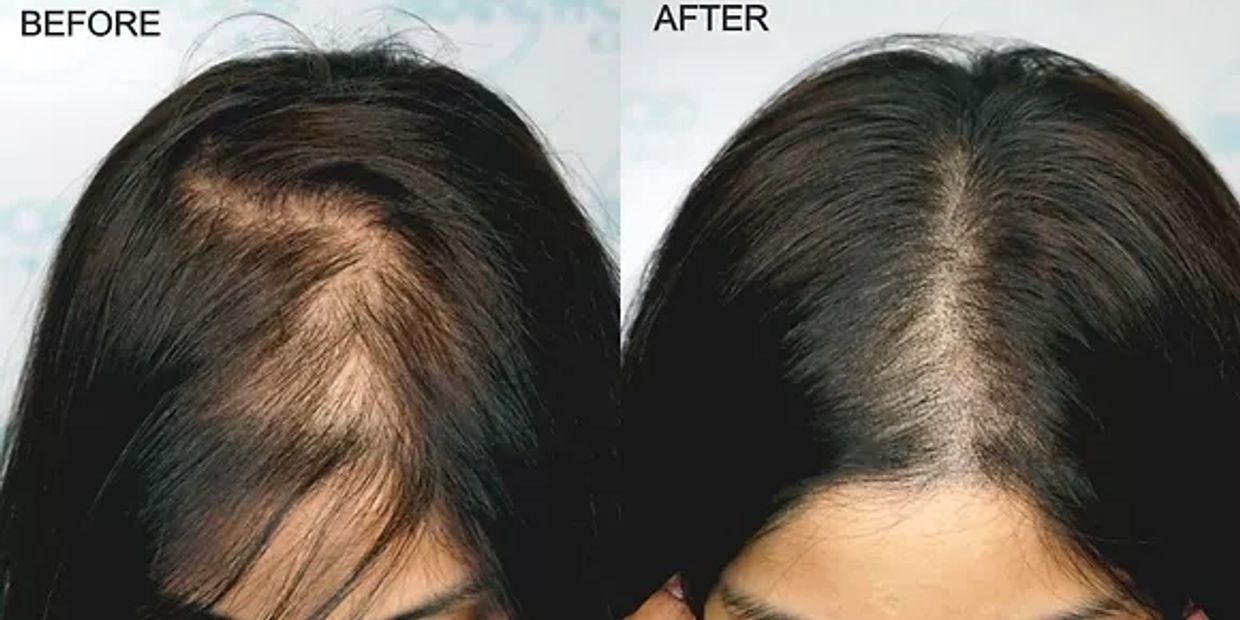 SMP in San Diego- Hair Loss Solutions for All Genders - Schedule a FREE Consultation to Learn More