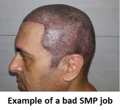 The Hair Artist Scalp Micropigmentation Hair Replacement Alopecia